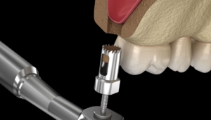 sinus lift procedure
