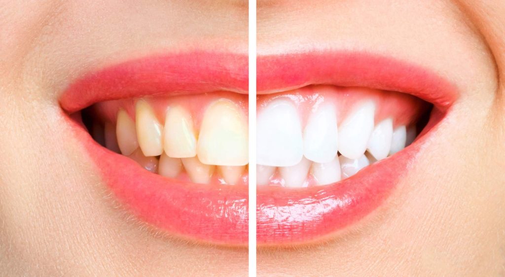 teeth whitening