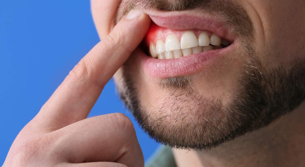 gum sensitivity