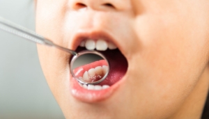 what is the main cause of cavities