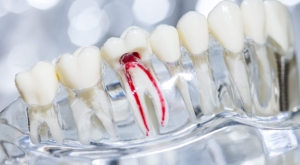 root canal tooth decay treatment
