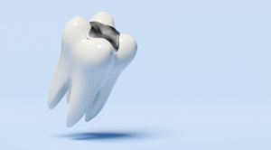 what is a dental buckle filling