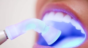 what is a dental filling